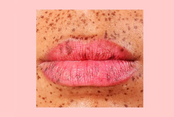 How to Heal Cracked Lip Corners Fast